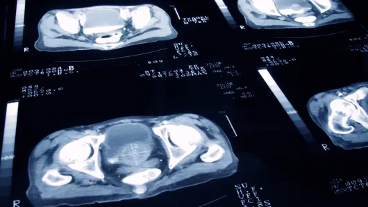 prostate disease