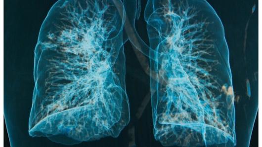 An image of highlighted veins in the lungs.