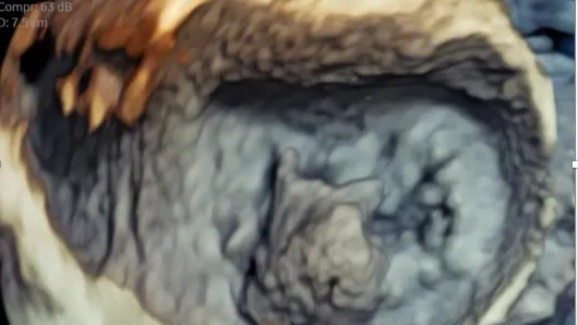 A 3d echo.