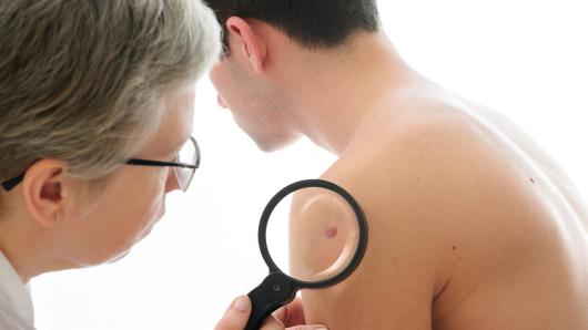 Doctor examining patient's mole.